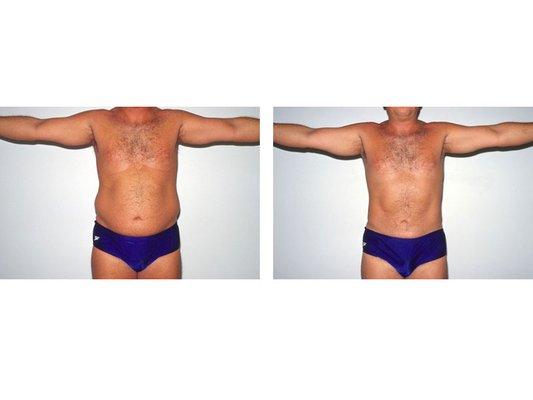 Liposuction Pre/post