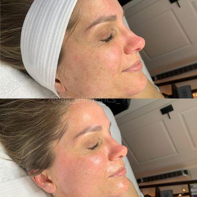 Dermaplaning B&A