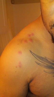 DONT STAY HERE THEY ARE INFESTED WITH BED BUGS!!!! This is just a few of the bites. My family and i are covered from head to to!!! Seriously