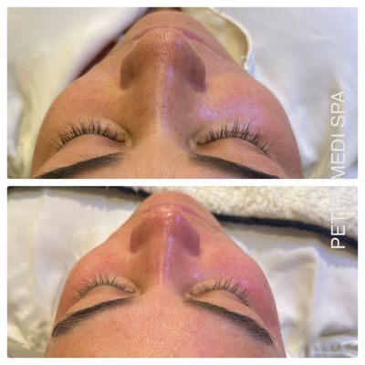 Before and after HydraFacial