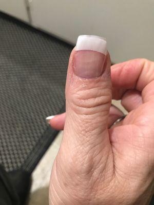 Crooked thumb nail!