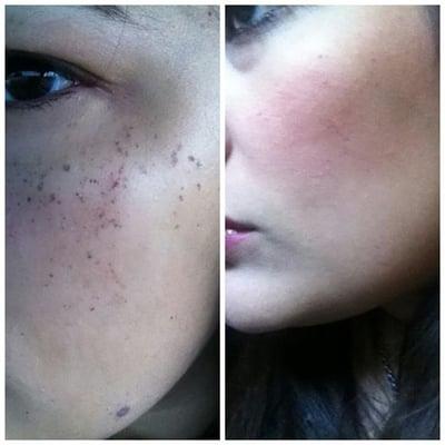 Photo Facial / IPL Before &  After ONE TREATMENT!!