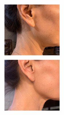 Sculptor artisan skin tightening before and after 3 sessions