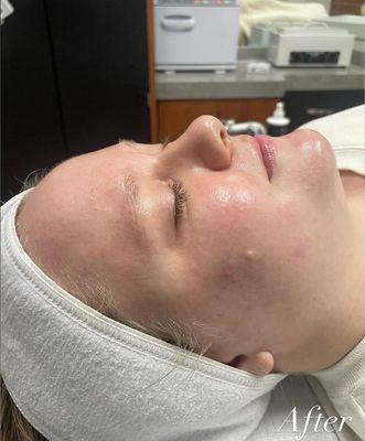 DERMAPLANE FACIAL