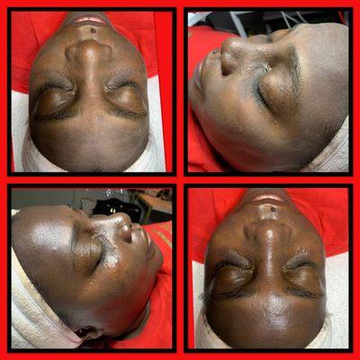 Microdermabrasion Facial