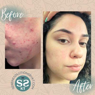 Acne and Rosacea Treatment