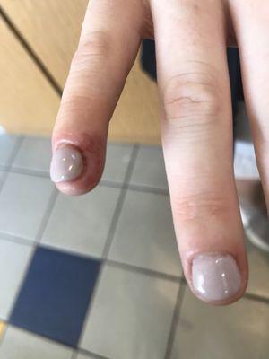 My damaged nail