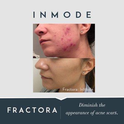 Diminish the Appearance of Acne Scars! #fractora