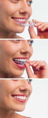 Invisalign  Clear braces