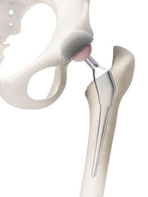 Total Hip Replacement anatomical model.