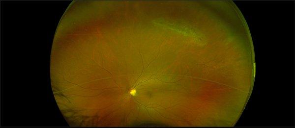 Retinal hole uncovered by wide-field retinal imaging on a routine exam.