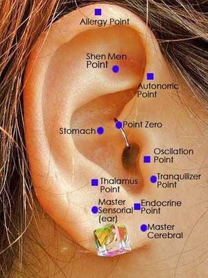 Auricular (Ear) Acupuncture in Pembroke Pines.