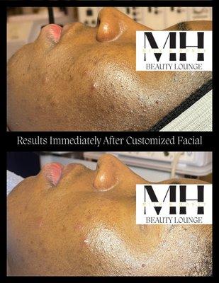 Microdermabrasion (Exfoliation that buffs away dead skin cells, revealing a even tone and youthful glow) Before & After