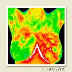 Thermographic scan showing firbrocystic tissue