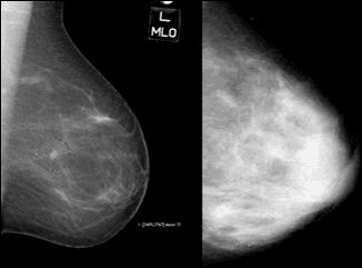 Dense Breast Tissue White so are Tumors