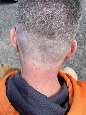 Razor burn haircut.