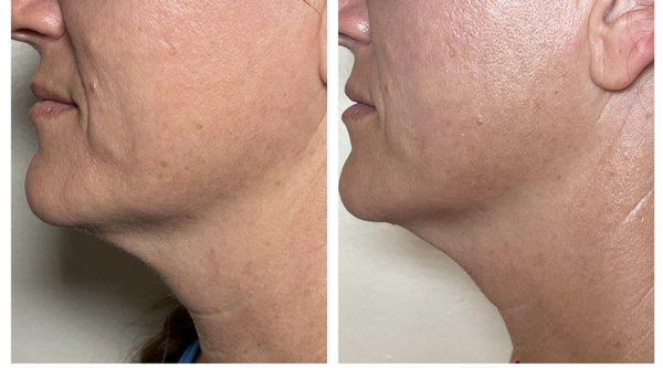 Skin tightening and toning