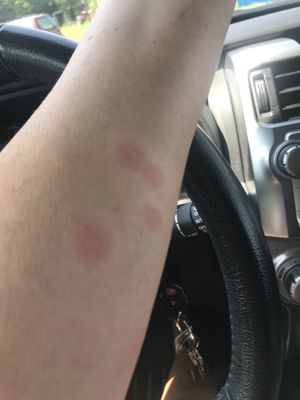 Bed bug bites.  53 Webber street York Maine.