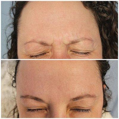 Botox - glabella "11s"