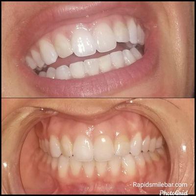 60 minute  whitening session