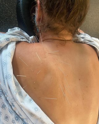 Dry Needling