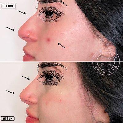 Non-surgical rhinoplasty