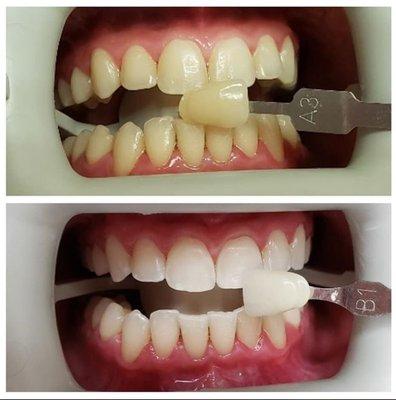 Spring Clean your Smile! Easy in office bleaching done in 1 hour.