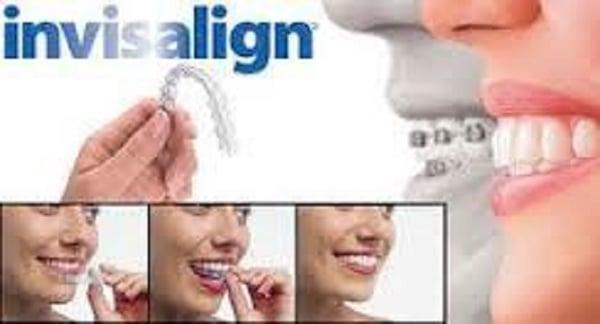 Invisalign-Plattsburgh-NY