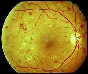 Right eye. Diabetic Retinopathy