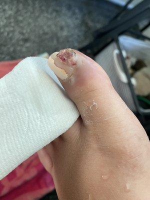 Worsening ingrown infected toenail