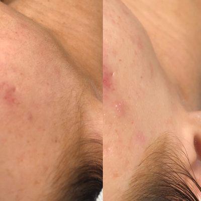 Dermaplane Facial (before and after)