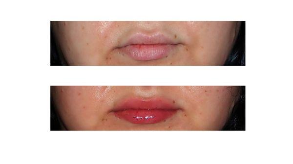 Before & After Skinnicity Lip Plumper