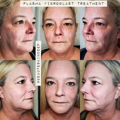 Plasma fibroblast treatment that's 2 weeks post treatment. 
Call for information and the special running now.