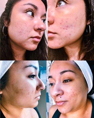 Look at that acne progress! Jenni's skin has cleared up so quickly!