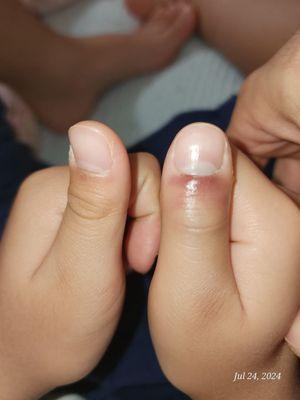 Bruised right thumb after being hit by thick roller foam swung by one the coaches. My son couldn't bend his thumb anymore afterwards.