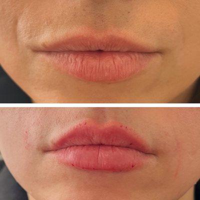 Lip Filler