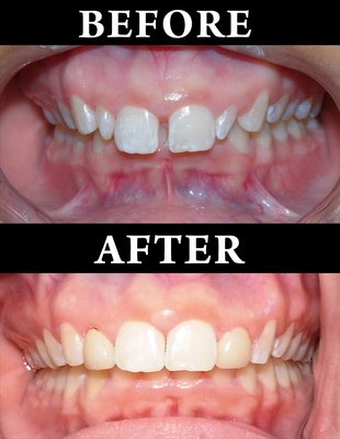 Invisalign results