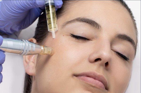 PRP microneedling facial.