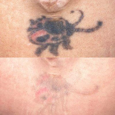 5 sessions into tattoo removal.