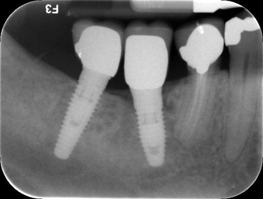 Implants replacing missing tooth