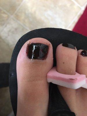 Bad pedicure