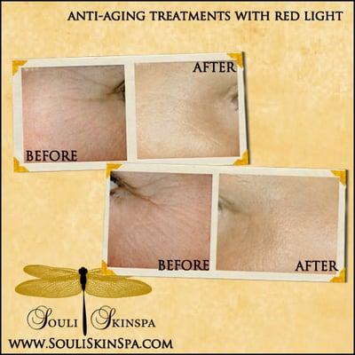 anti-aging light therapy