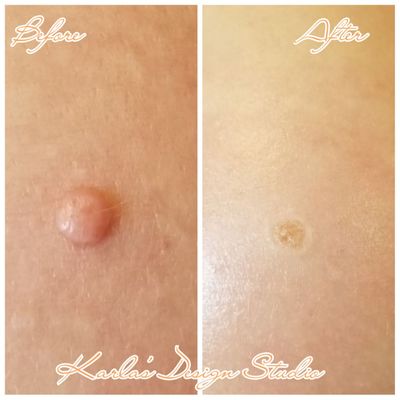 Skin tag Removal