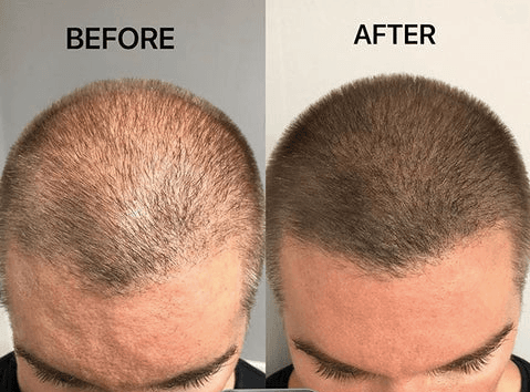 Scalp Micropigmentation for Men