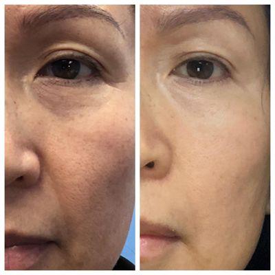 Before and After: TrueContour facial contouring  with 1 Limelight IPL PhotoFacial, and 3 Laser Genesis treatments.