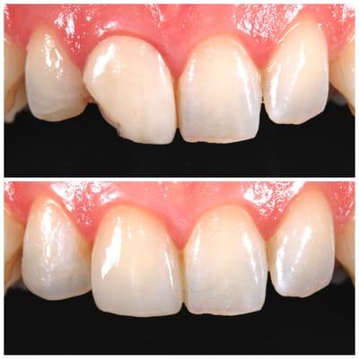 Central incisor was restored with a beautiful new crown