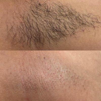 underarm wax before & after