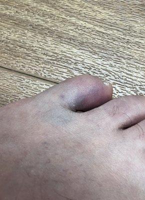 Broken toe