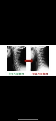 Reversal of neck curve after car crash