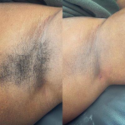 Underarm wax before and after